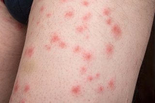 Bed Bug Bites